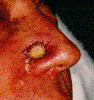 skin cancer nose graft.gif